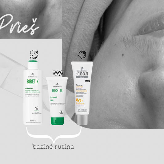 Aknės priežiūros rutina