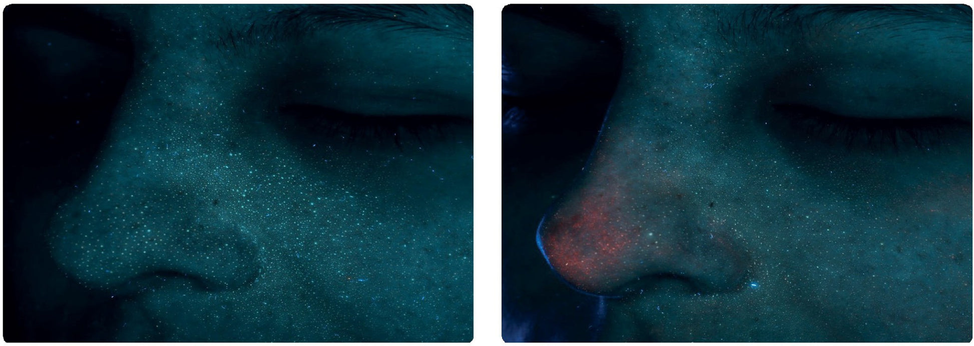 BIRETIX rūgštinis tonikas su AHA – riebalavimosi mažinimas ir spuogų prevencija, heyskin.lt